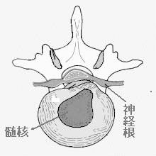 膨隆型椎間板ヘルニアの図